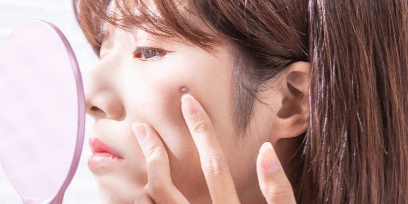 Acne scar | Chelsea Clinic