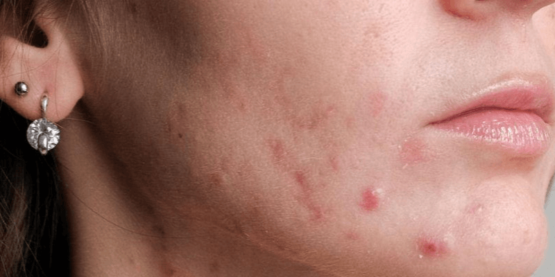 Active Acne | Chelsea Clinic
