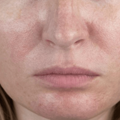 Pigmentation | Chelsea Clinic
